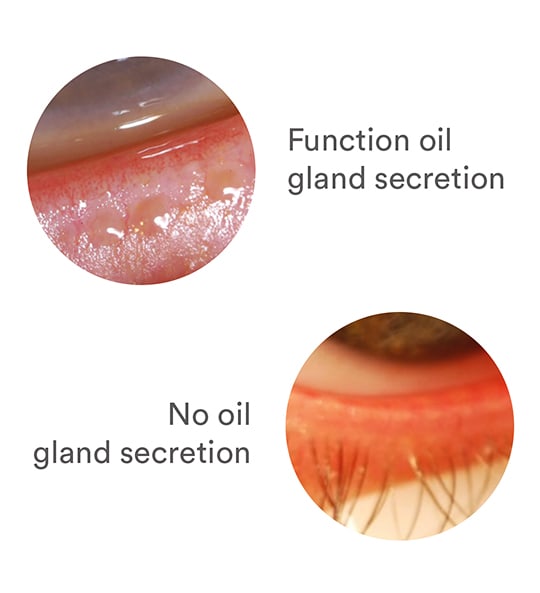 Image comparing oil gland secretion versus no oil secretion