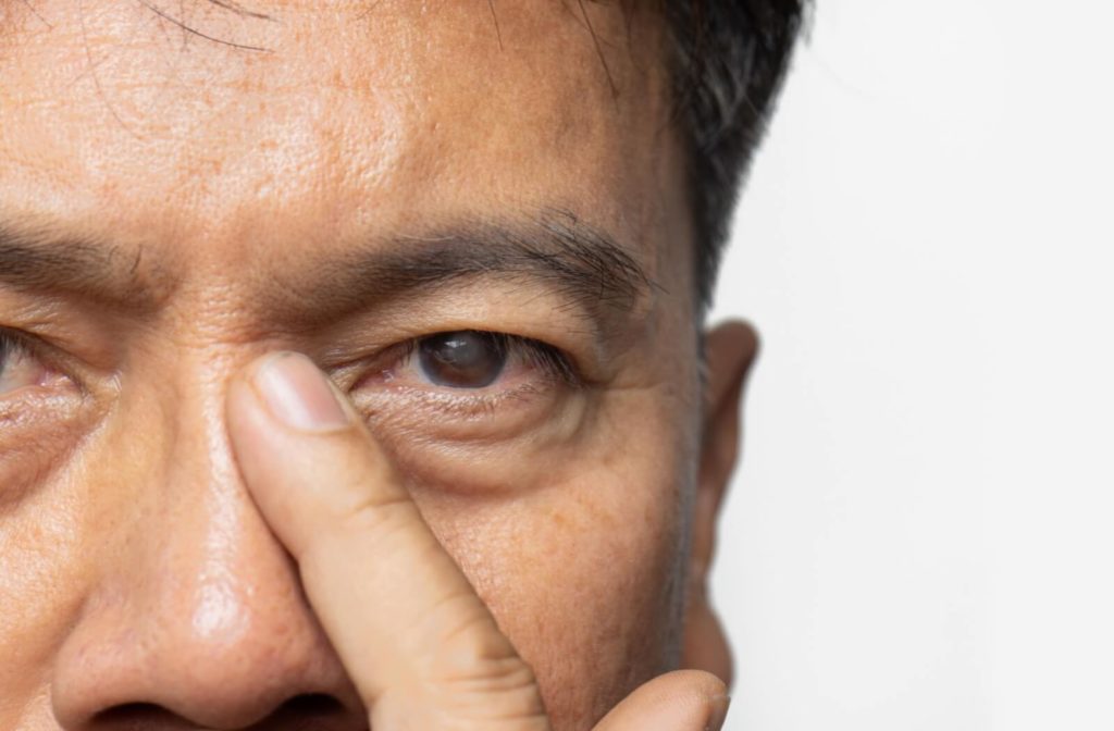 A close-up of a patient's eye clouded over due to cataracts.