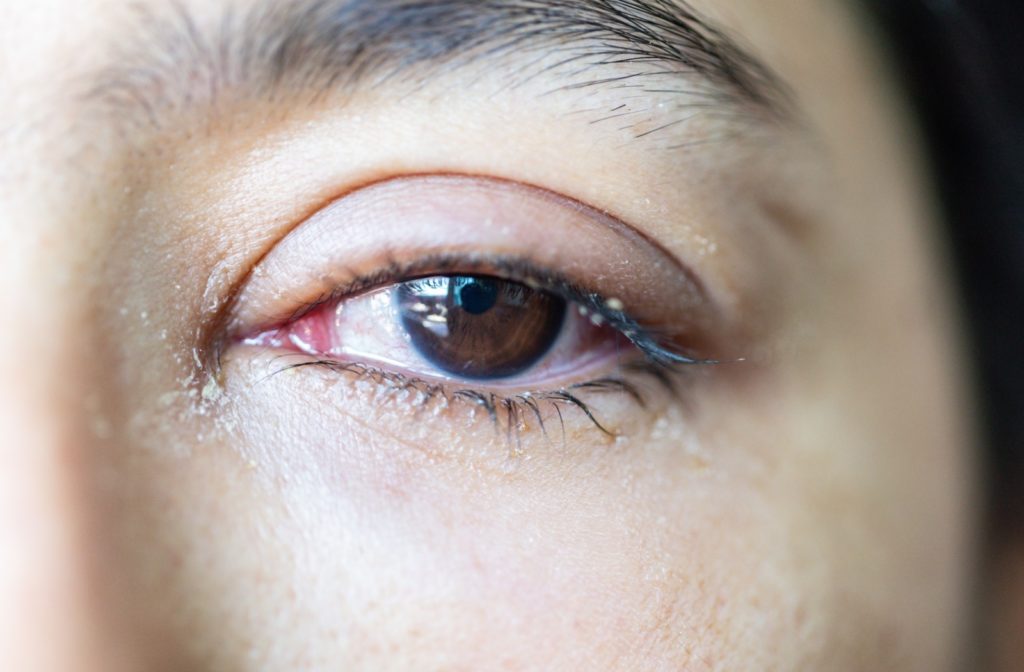 A close-up of a watery, irritated eye.