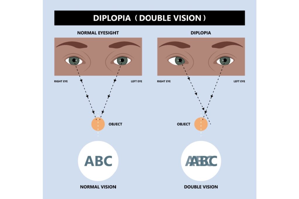 Diagram explaining diplopia (double vision). The left side shows normal eyesight with both eyes focusing on the same object, resulting in a single clear image labeled ‘ABC.’ The right side illustrates diplopia, where the eyes do not align correctly; their focus points diverge, producing two overlapping images of the text ‘ABC.’ Arrows from each eye show how visual pathways differ between normal vision and double vision.
