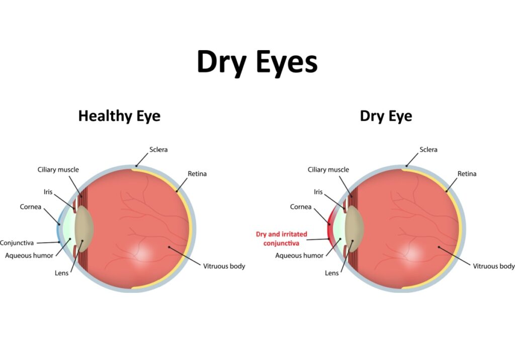 Medical illustration comparing a healthy eye and a dry eye, showing the tear film and labeled structures like the cornea, conjunctiva, and retina.