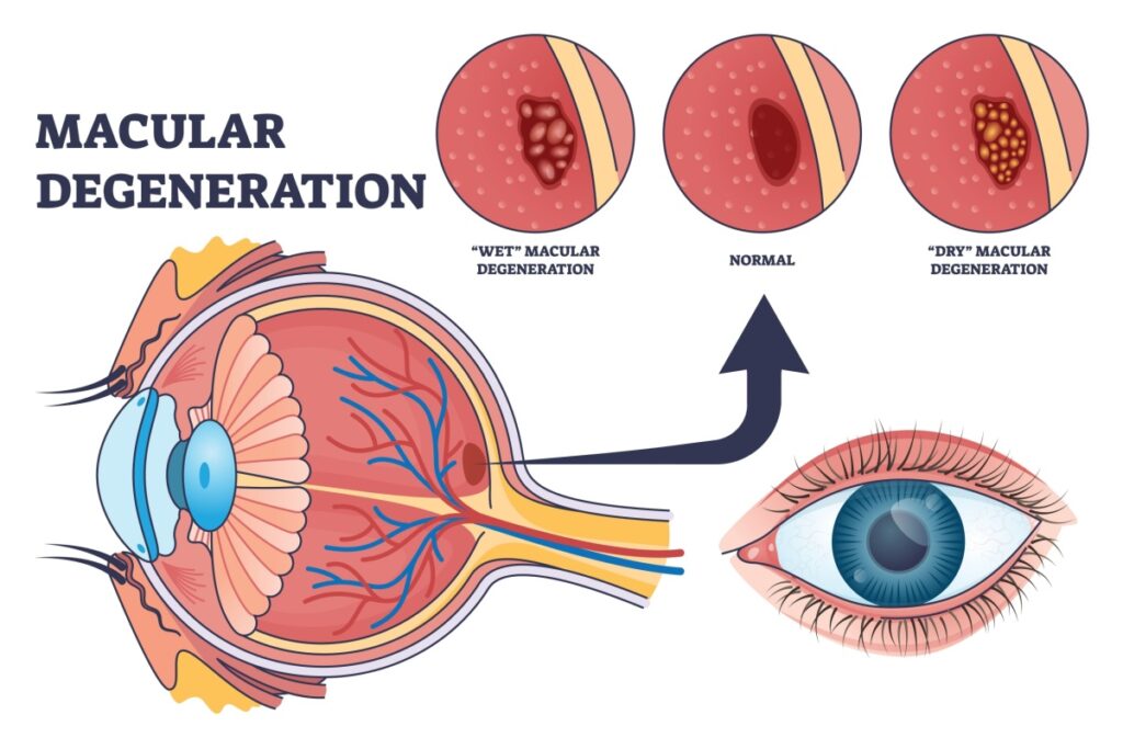 Medical illustration showing cross-section of eye with macular degeneration, comparing wet and dry forms with detailed anatomical labels and retinal changes.