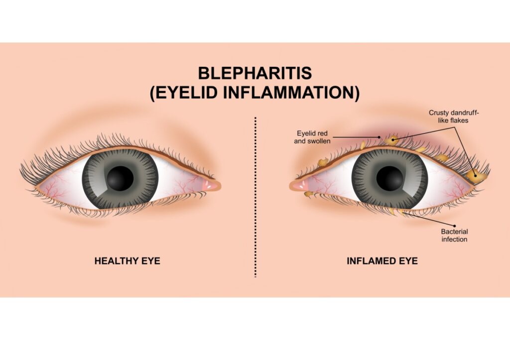 normal eye vs eye with blepharitis inflammation comparison diagram.